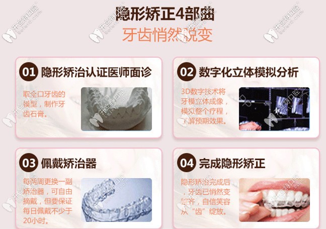 無托槽隱形矯正器的優(yōu)勢