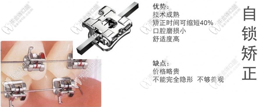 金屬自鎖矯正的特點