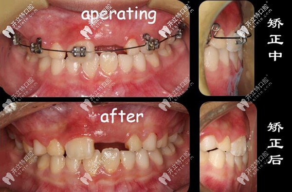 染指弘瑞口腔兒童地包天矯正案例