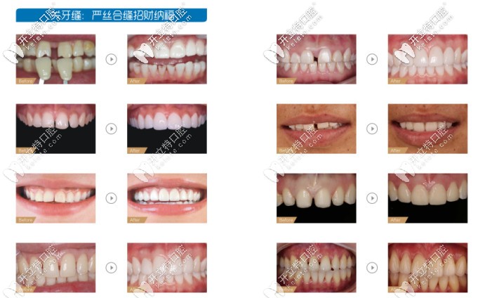 美學修復前后對比圖