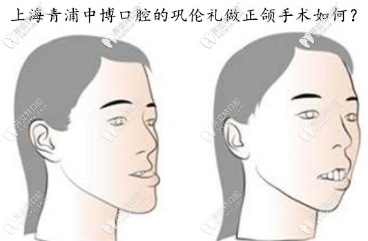 誰知道上海中博口腔做地包天正頜手術(shù)的醫(yī)生是誰？