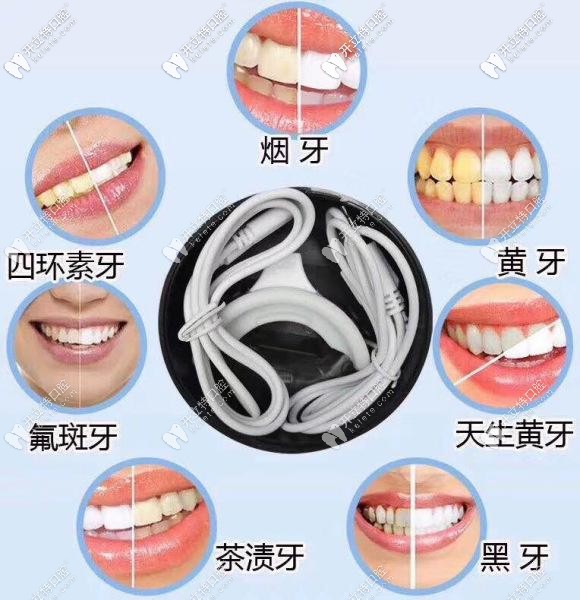 牙齒有這些情況都可以通過美白來改善 牙齒有這些情況都可以通過美白來改善