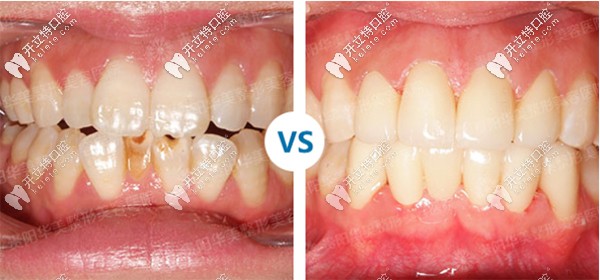 貴陽華美口腔修復(fù)案例