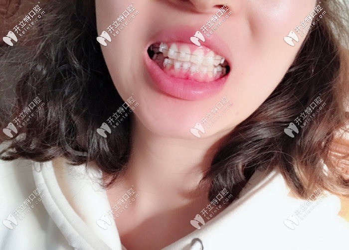 剛帶上牙套的圖片 剛帶上牙套的圖片