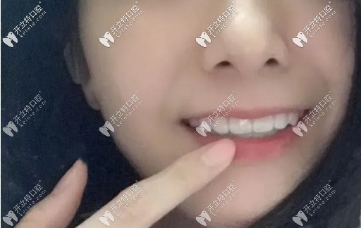 摘下牙套的圖片 摘下牙套的圖片