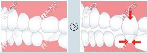 缺牙久了鄰牙也會(huì)受到影響
