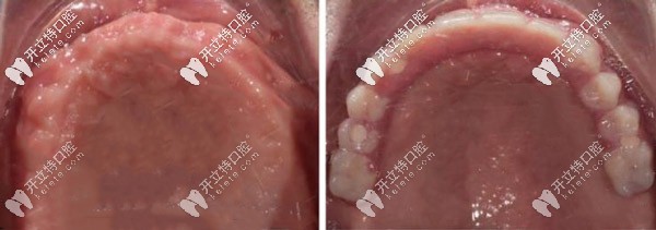 ALL-ON-4半固定種植前后對(duì)比照