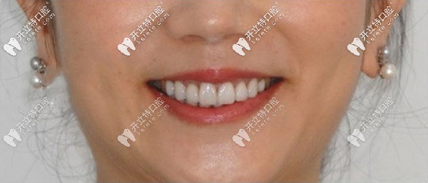 做前牙美學(xué)貼面后