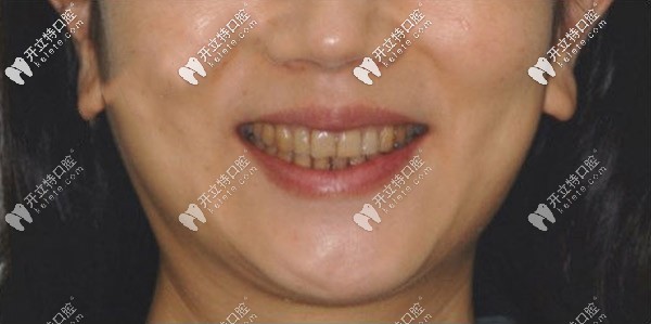 做牙齒貼面前