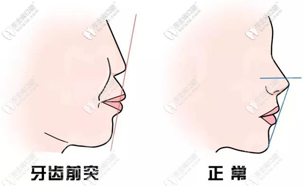 通過(guò)整牙可以改變嘴凸 通過(guò)整牙可以改變嘴凸