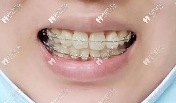 戴冰晶托槽矯正一年半的效果 戴冰晶托槽矯正一年半的效果
