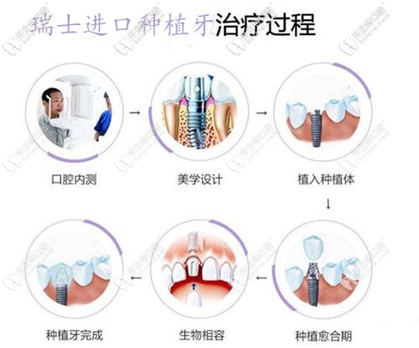 瑞士進(jìn)口種植牙治療過程 瑞士進(jìn)口種植牙治療過程