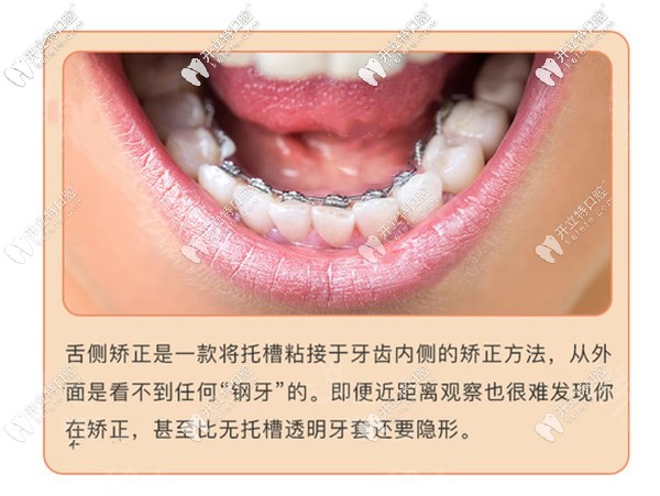 廣州舌側(cè)矯正哪個(gè)醫(yī)院好?廣州舌側(cè)成熟醫(yī)院醫(yī)生及價(jià)格推薦