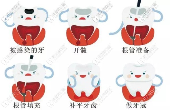 牙齒做根管治療的示意圖