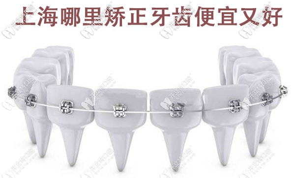 上海哪里矯正牙齒便宜又好，這些有名的牙科醫(yī)院值得選擇