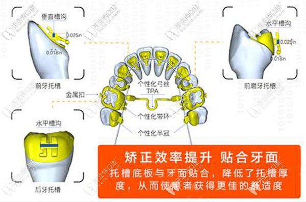 舌側(cè)全隱形矯正的特點