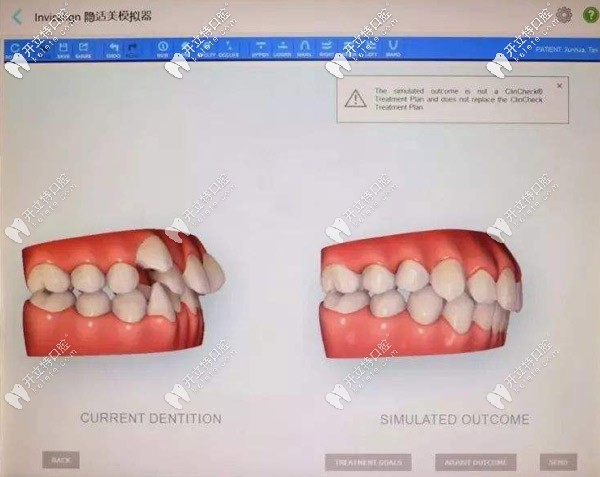 無托槽隱形矯正器的特點