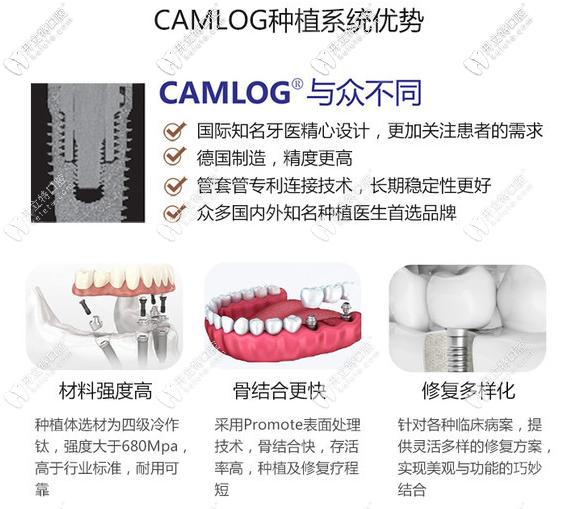 德國種植牙優(yōu)勢(shì)