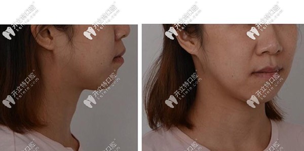 開頜案例側(cè)面照 開頜案例側(cè)面照