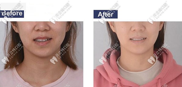 矯正前后臉型對比圖 矯正前后臉型對比圖