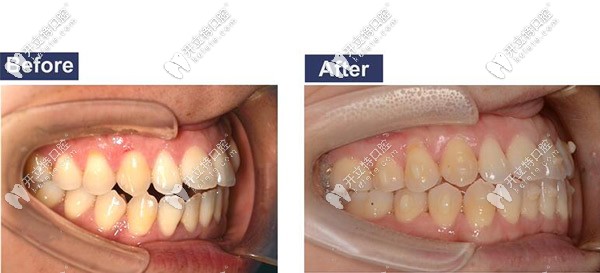 開頜矯正側(cè)面圖 開頜矯正側(cè)面圖