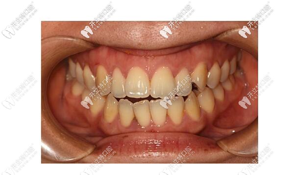 河源恒信口腔牙齒矯正前 河源恒信口腔牙齒矯正前