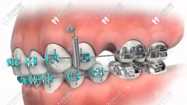 正畸過程打骨釘示意圖 正畸過程打骨釘示意圖