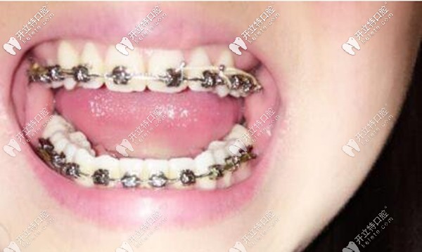 在晉城王國飛口腔做矯正一年多的效果圖 在晉城王國飛口腔做矯正一年多的效果圖