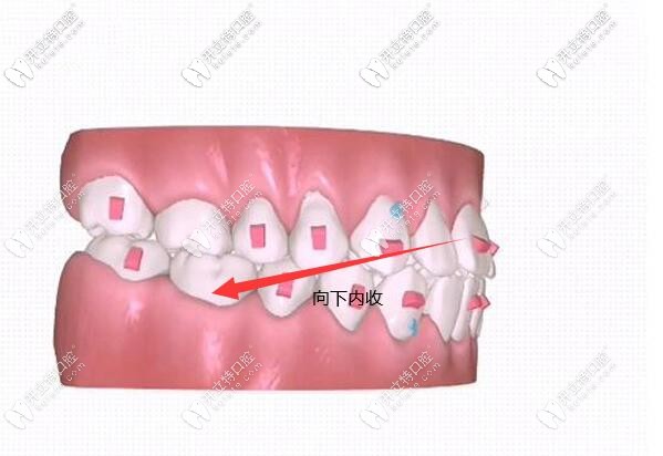 前牙壓低向下內(nèi)收 前牙壓低向下內(nèi)收