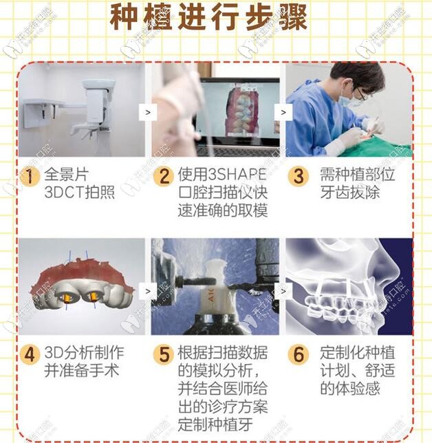 深圳麗雅口腔微創(chuàng)種植牙步驟 深圳麗雅口腔微創(chuàng)種植牙步驟
