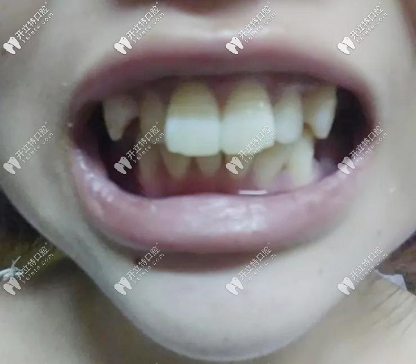 戴牙套前牙齒正面照