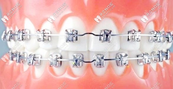 金屬自鎖托槽牙套