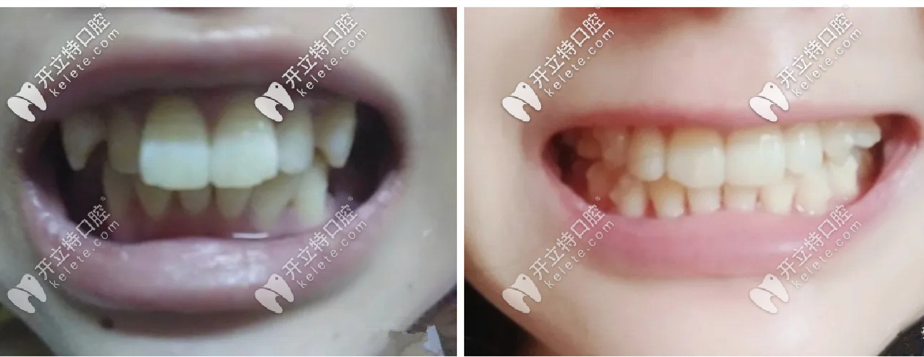 一年半的時間，牙套已經(jīng)變得<span style=