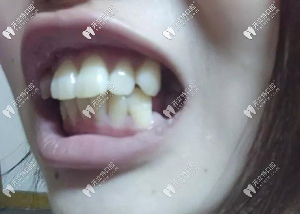 牙齒的側(cè)面照，外凸的厲害
