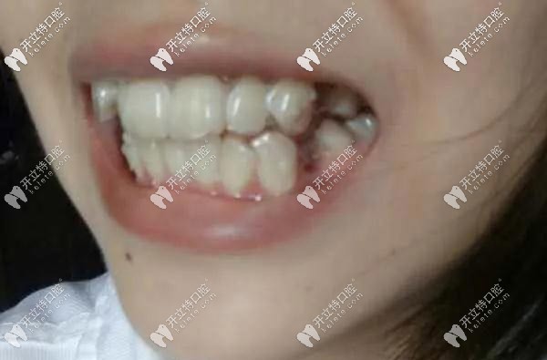 你能看到隱形牙套的附件嗎