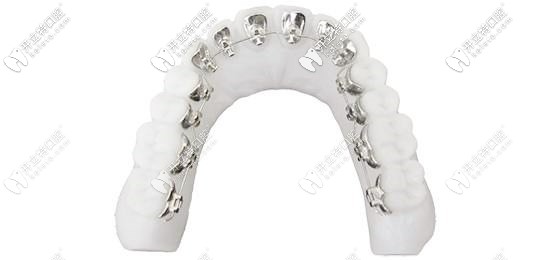 舌側(cè)隱形矯正器