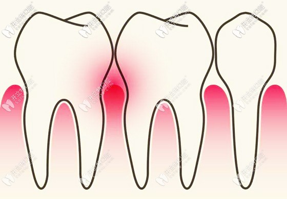 牙周炎癥示意圖 牙周炎癥示意圖
