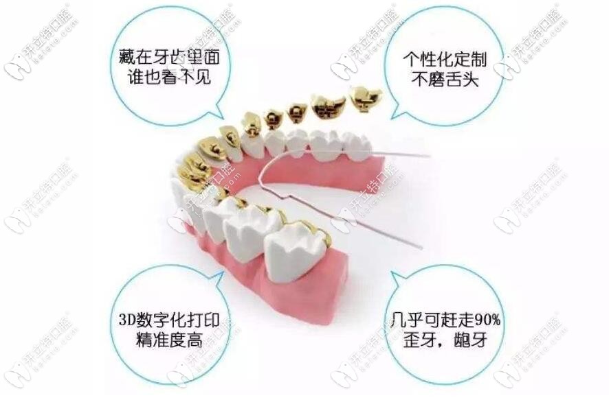 舌側(cè)矯正優(yōu)勢(shì)