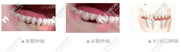 做種植牙類別圖 做種植牙類別圖