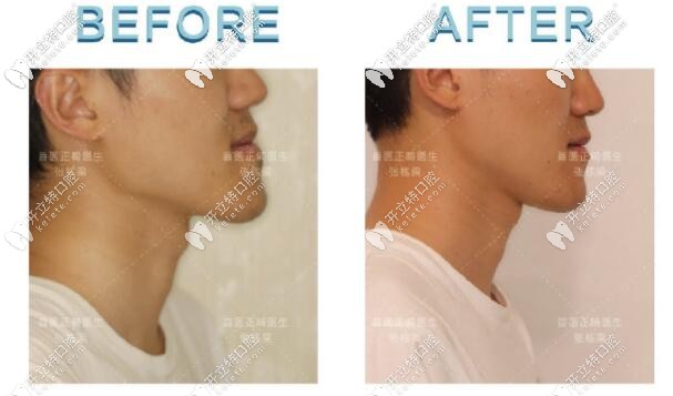 骨性III類(lèi)地包天小哥哥，矯正后側(cè)臉對(duì)比圖