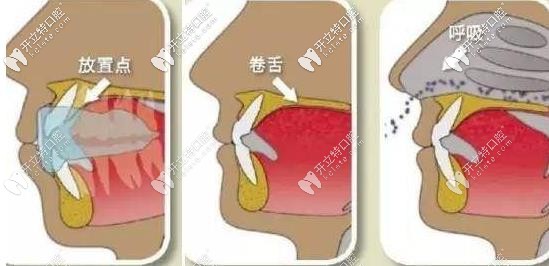 MRC的矯正放置位置