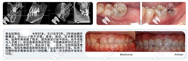沈陽盛大口腔單顆牙缺失案例