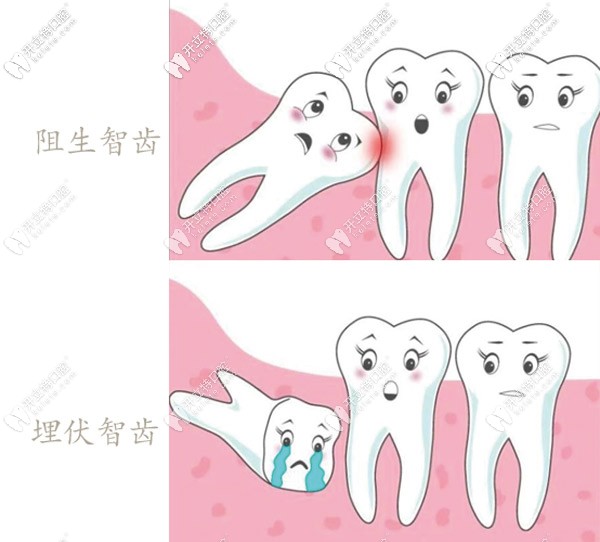 阻生智齒和埋伏智齒 阻生智齒和埋伏智齒