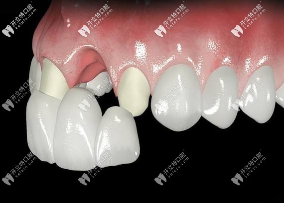 全瓷牙套的壽命是幾年?能用一輩子嗎？