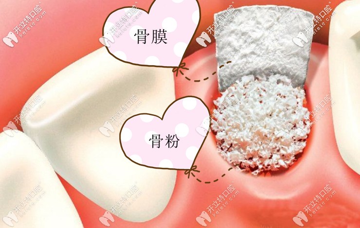 種植骨粉的價(jià)格是多少