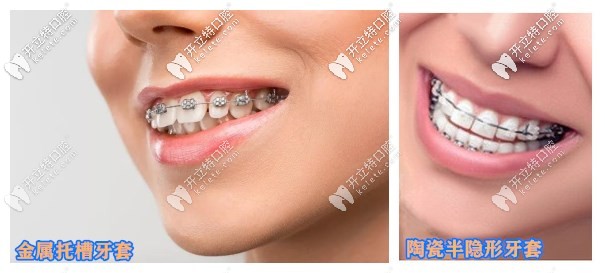 金屬牙套和半隱形陶瓷牙套