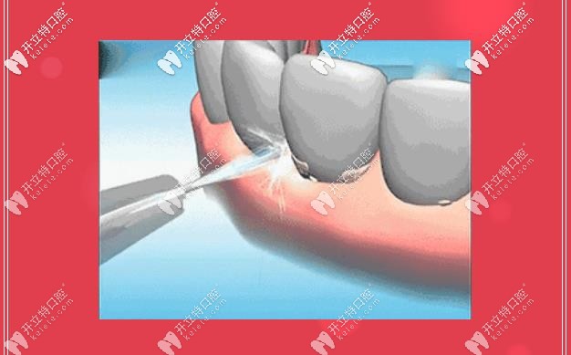 洗牙，給你牙齒干凈清爽