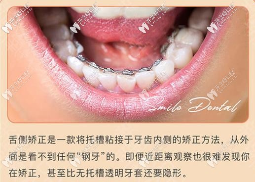 舌側(cè)隱形牙齒矯正好處 舌側(cè)隱形牙齒矯正好處