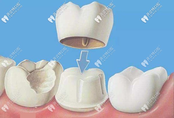 烏市做牙齒治療的收費(fèi)參考