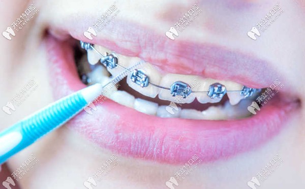 烏魯木齊做牙齒矯正的參考價(jià)格
